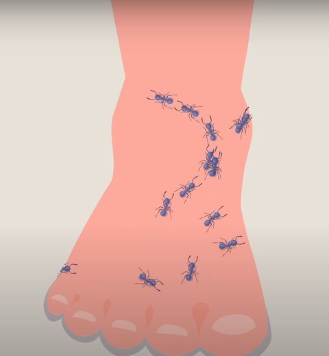 Fuß mit Polyneuropathie, Ameisenkrabbeln als Missempfindung