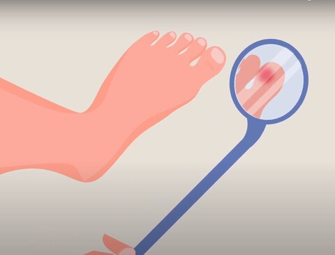 Fußkontrolle mit Lupe, bei Diabetes ein Muss