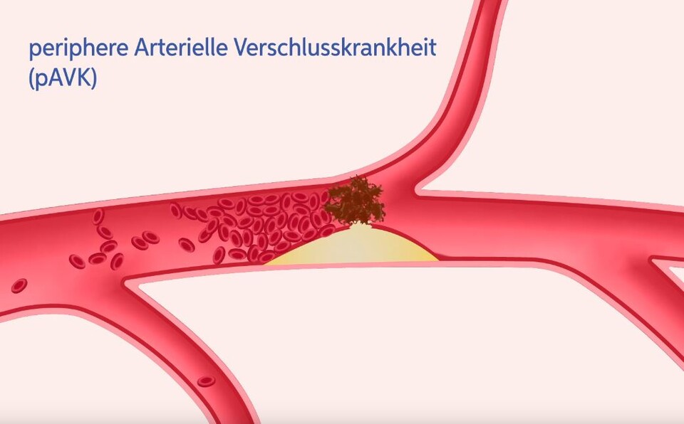 Periphere arterielle Verschlusskrankheit pAVK, Arterien sind nicht mehr durchlässig